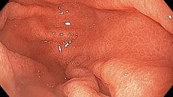 Нр ассоциированный гастрит